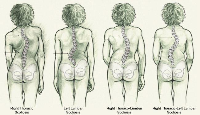 最新脊柱側彎治療方法及其奇妙之旅